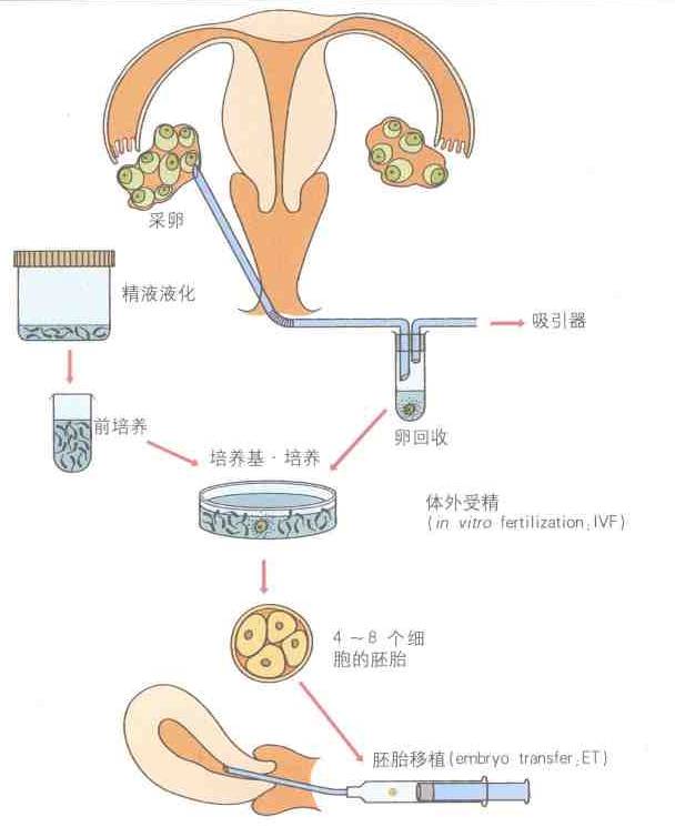 体外受精