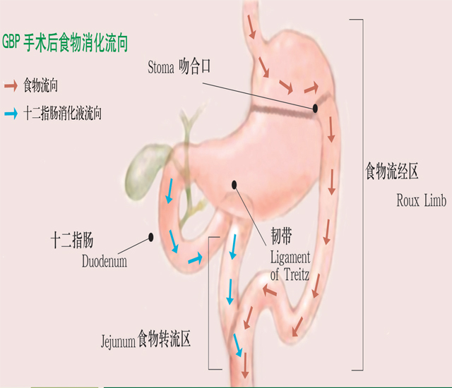 胃转流