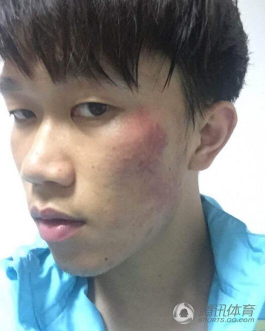 谢鹏飞被打伤 谢鹏飞被打伤