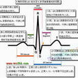 心电图U波
