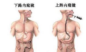 嗜酸性粒细胞性胃肠炎--病理